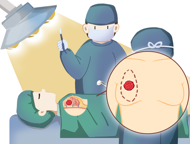 一次手術(shù)實(shí)現(xiàn)“腫瘤切除+外形重塑”