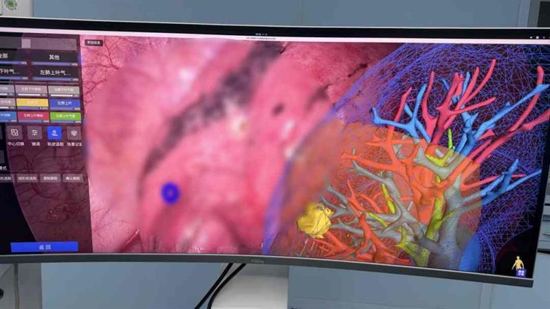 數智驅動，精準破局：南方醫院胸外科成功實施高難度“數字孿生”導航肺結節切除術