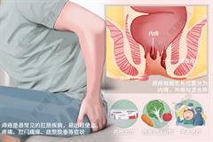 痔疮