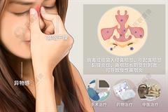 慢性鼻咽炎