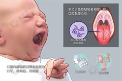 婴儿鹅口疮