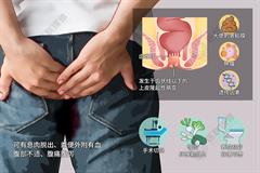 肛门息肉