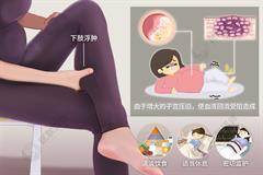 孕妇小腿浮肿