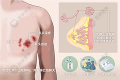 男性乳腺癌