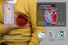 三度房室传导阻滞