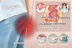 肛门直肠周围脓肿