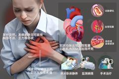 急性心肌梗塞