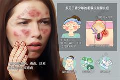 青春痘