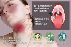 扁桃体炎
