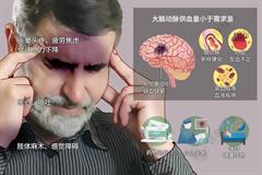 脑供血不足