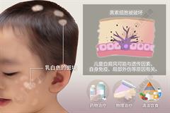 儿童白癜风