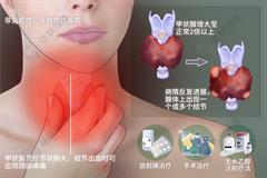 结节性甲状腺肿