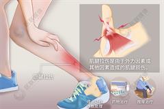 肌腱拉伤