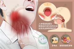 咽喉炎