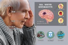脑梗塞