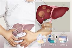 肝囊肿