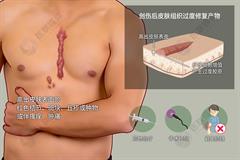 瘢痕疙瘩