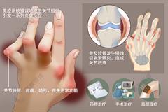 类风湿性关节炎