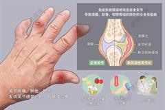 类风湿关节炎