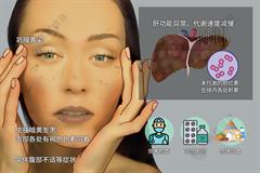 肝病面容