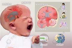 小儿脑积水