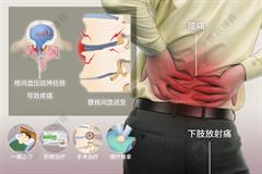 腰间盘突出症