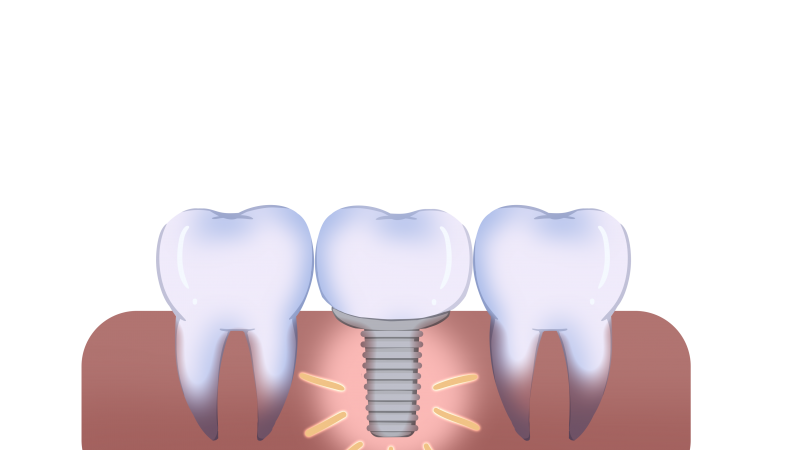 種牙后腫脹別慌！正確處理方法一文講透