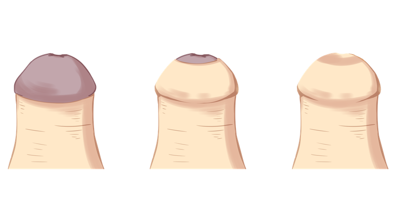 割，还是不割？关于包皮的困惑，医生一次全说清楚了