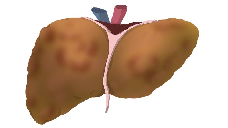 【全国爱肝日】瘦人也难逃脂肪肝“魔爪”？医生：这是健康陷阱