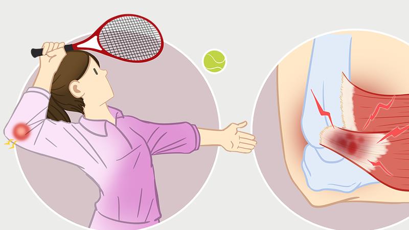 惊蛰护肘避风寒，中医教你通经络、调气血，远离“网球肘”