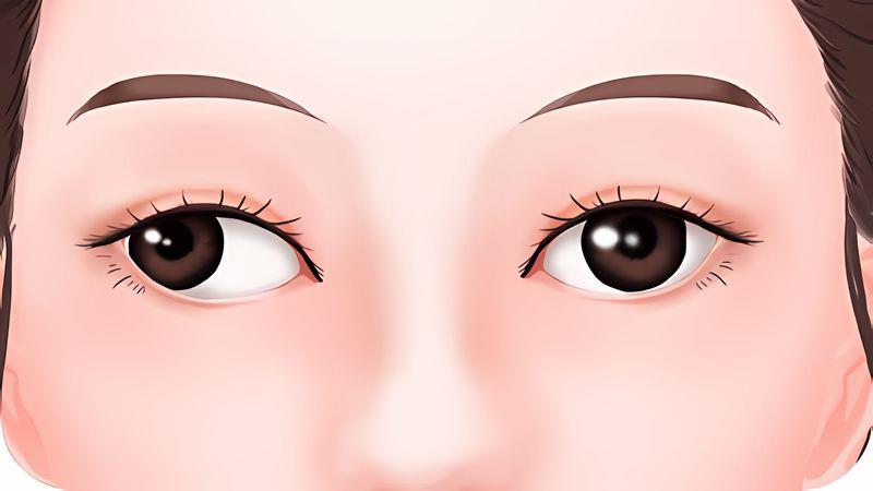 “斗鸡眼”困扰半生终得治 南医增城院区眼科助老人重获自信